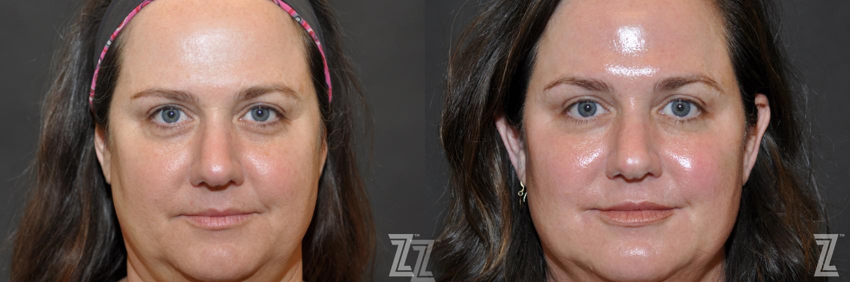 Injectable Fillers Before & After Photo | Austin, TX | The Piazza Center for Plastic Surgery & Advanced Skin Care