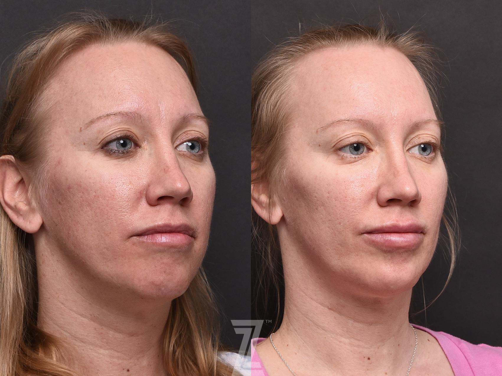 Botox, Neurotoxin, Dysport, Before and After, B&A, Tummy Tuck, Breast Aug, Breast Lift, Mastopexy, MMO, Mommy Makeover, Dr. Rocco Piazza, The Piazza Center, Austin, Tx, Halo, BBLlaser
