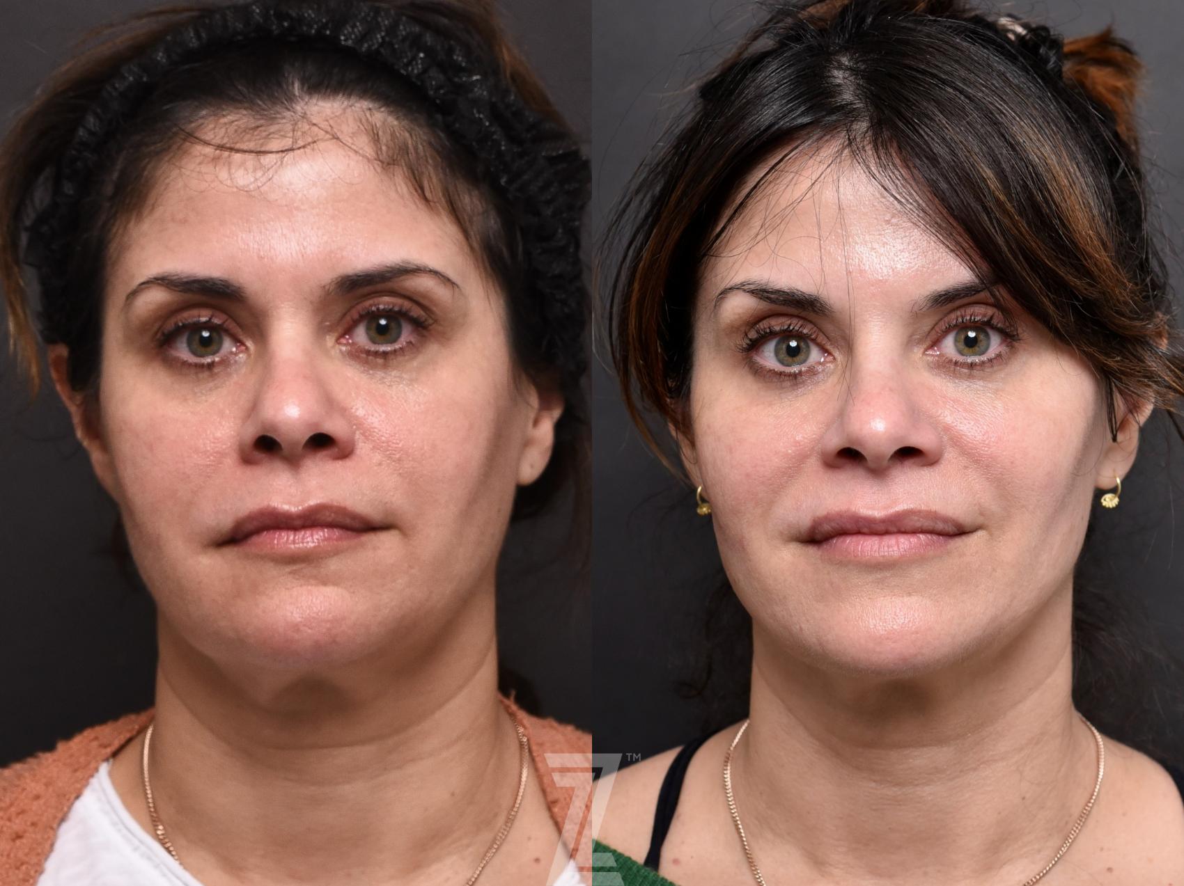 Botox, visia skin analysis, Neurotoxin, Dysport, Before and After, B&A, Tummy Tuck, Breast Aug, Breast Lift, Mastopexy, MMO, Mommy Makeover, Dr. Rocco Piazza, The Piazza Center, Austin, Tx, Halo, BBLlaser