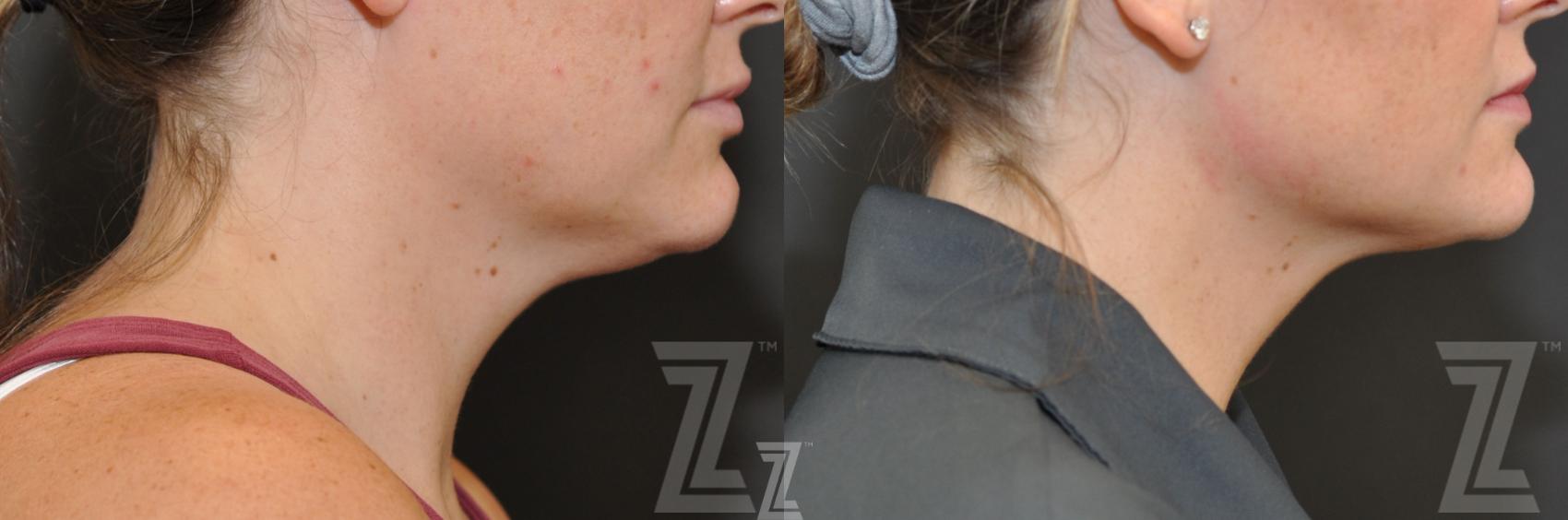 KYBELLA® Before & After Photo | Austin, TX | The Piazza Center for Plastic Surgery & Advanced Skin Care