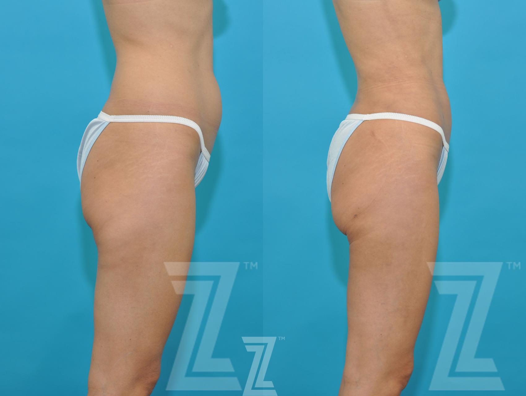 Liposuction Before & After Photo | Austin, TX | The Piazza Center for Plastic Surgery & Advanced Skin Care