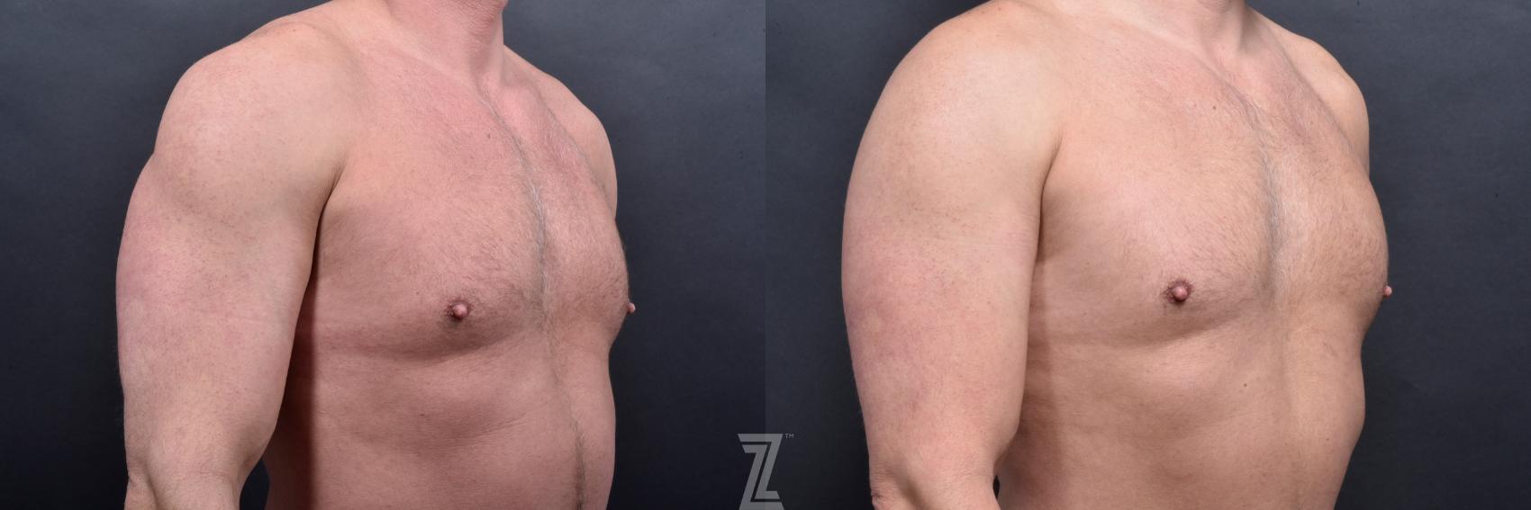 Liposuction Before & After Photo | Austin, TX | The Piazza Center for Plastic Surgery & Advanced Skin Care