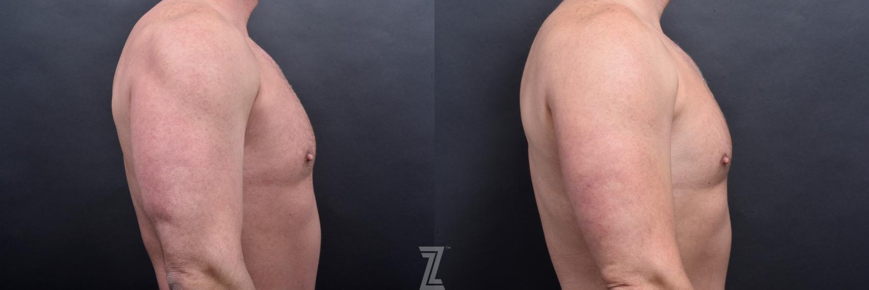 Liposuction Before & After Photo | Austin, TX | The Piazza Center for Plastic Surgery & Advanced Skin Care
