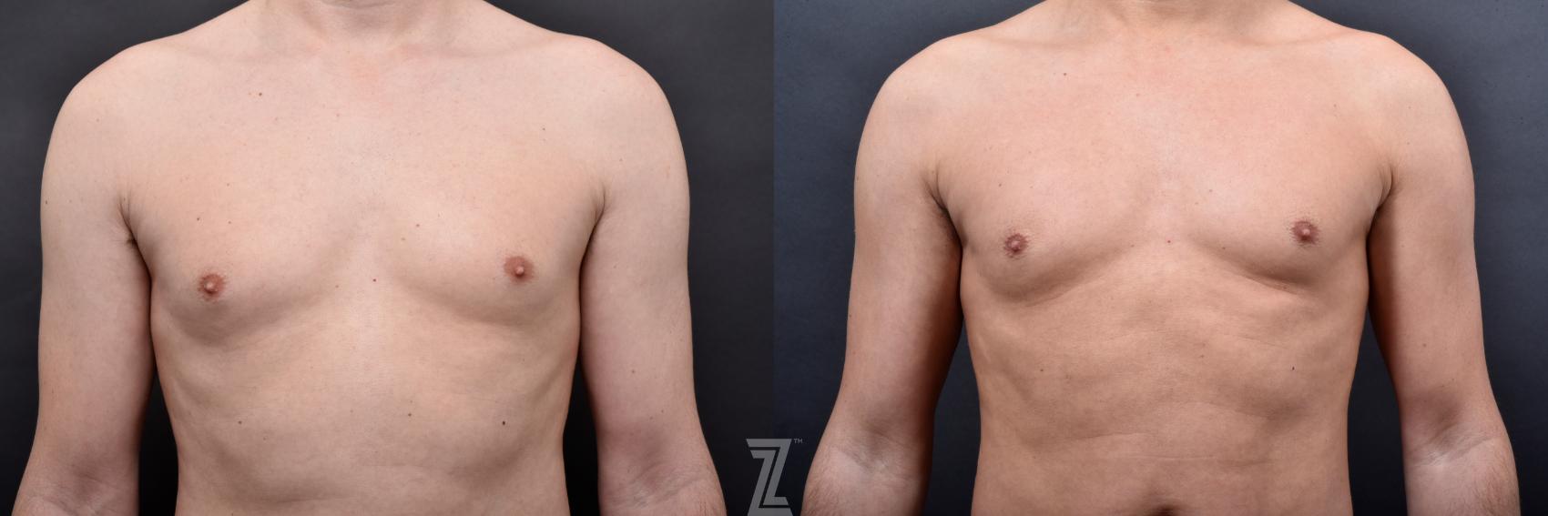 Liposuction Before & After Photo | Austin, TX | The Piazza Center for Plastic Surgery & Advanced Skin Care