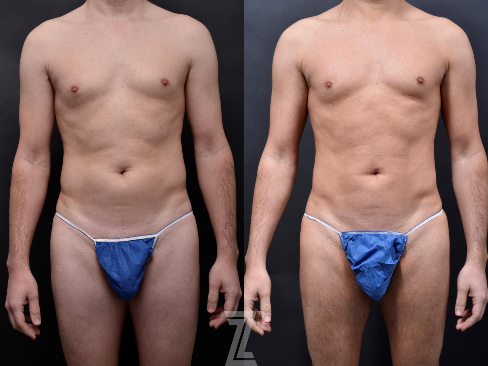 Fat Transfer Before & After Photo | Austin, TX | The Piazza Center for Plastic Surgery & Advanced Skin Care