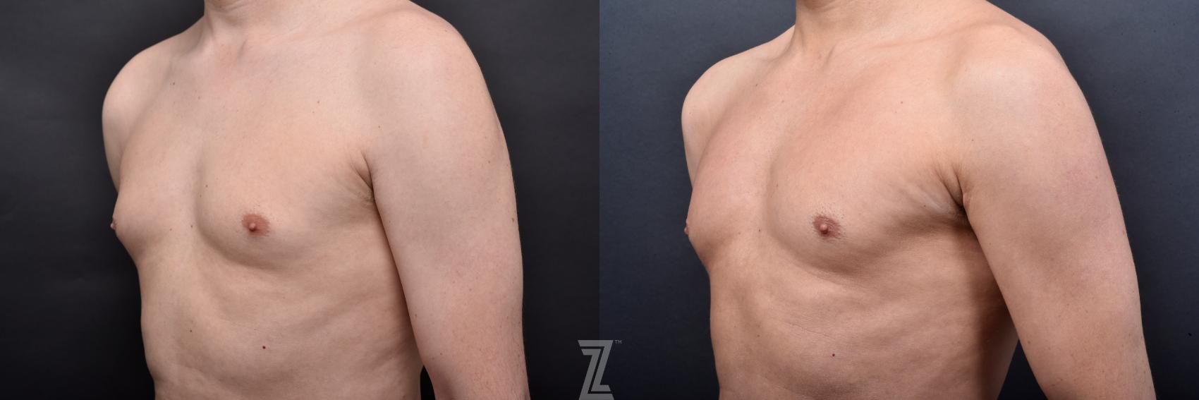 Liposuction Before & After Photo | Austin, TX | The Piazza Center for Plastic Surgery & Advanced Skin Care
