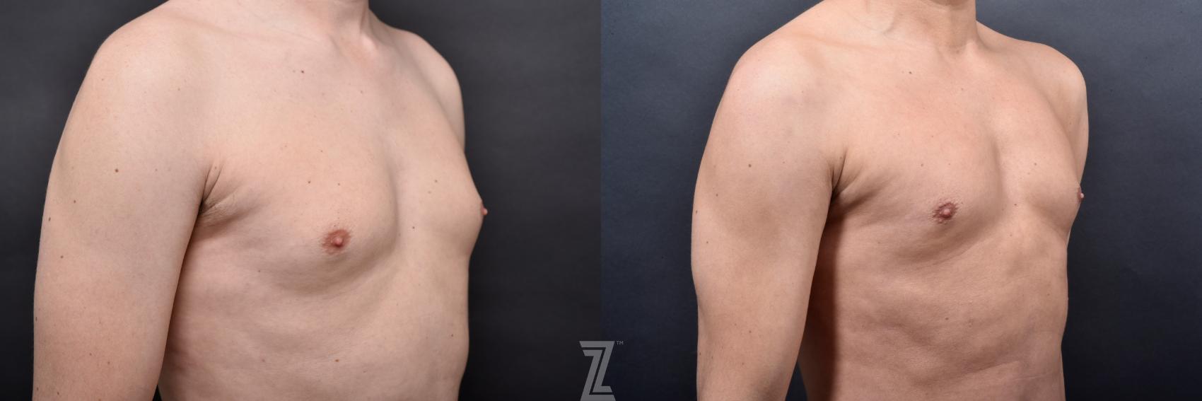 Liposuction Before & After Photo | Austin, TX | The Piazza Center for Plastic Surgery & Advanced Skin Care