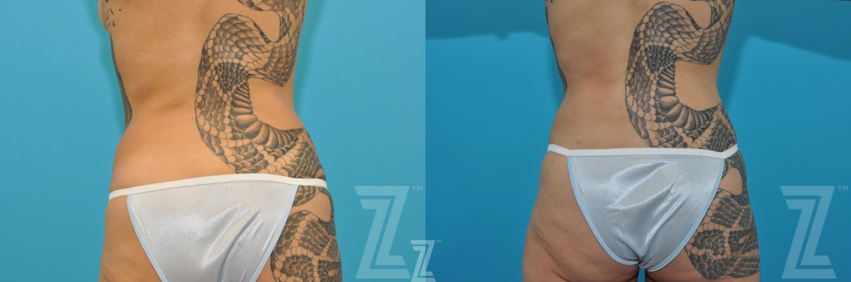 Liposuction Before & After Photo | Austin, TX | The Piazza Center for Plastic Surgery & Advanced Skin Care