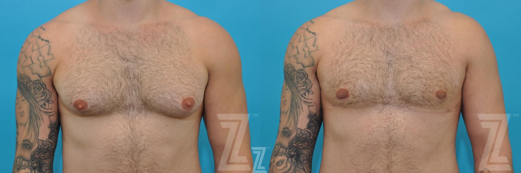 Male Breast Reduction Before & After Photo | Austin, TX | The Piazza Center for Plastic Surgery & Advanced Skin Care