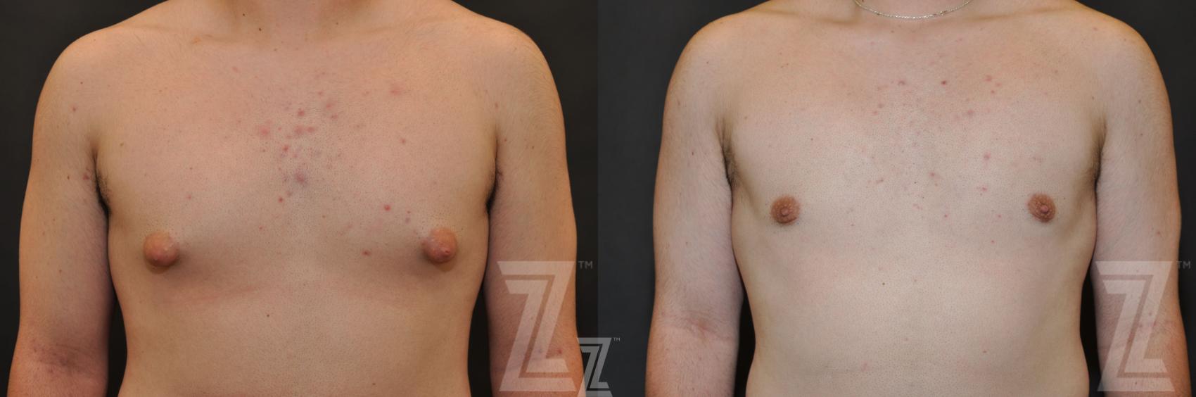 Male Breast Reduction Before & After Photo | Austin, TX | The Piazza Center for Plastic Surgery & Advanced Skin Care