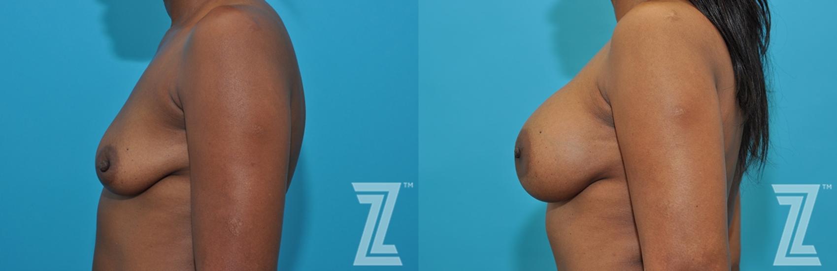 Mommy Makeover Before & After Photo | Austin, TX | The Piazza Center for Plastic Surgery & Advanced Skin Care