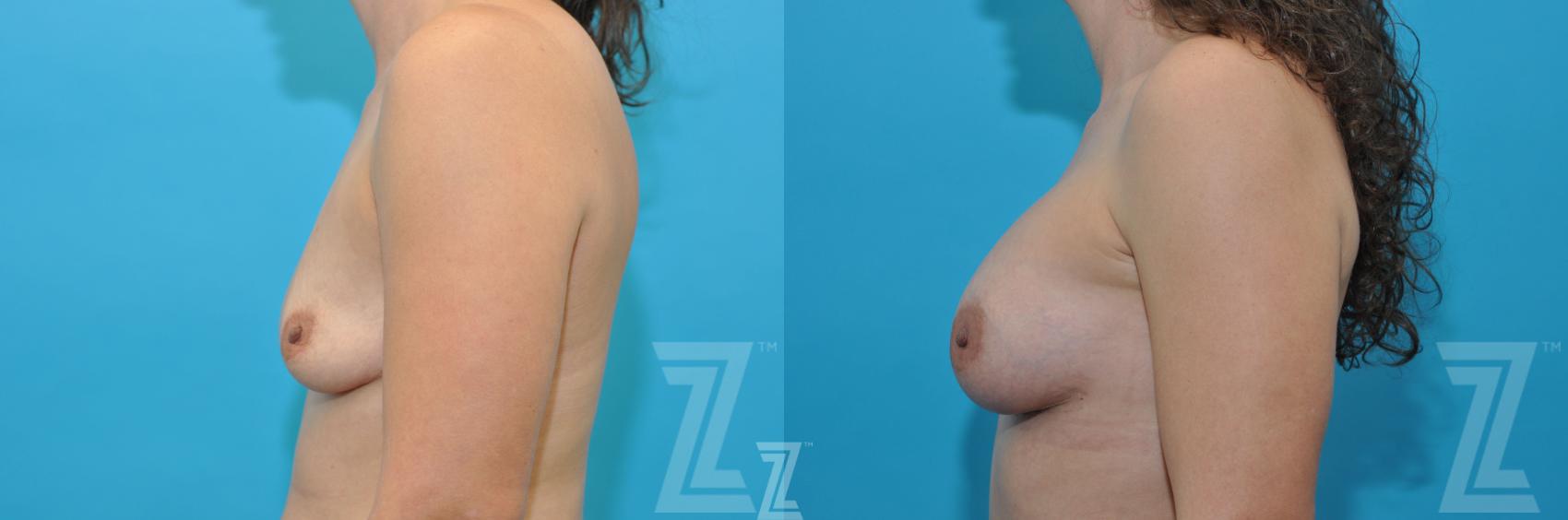 Mommy Makeover Before & After Photo | Austin, TX | The Piazza Center for Plastic Surgery & Advanced Skin Care