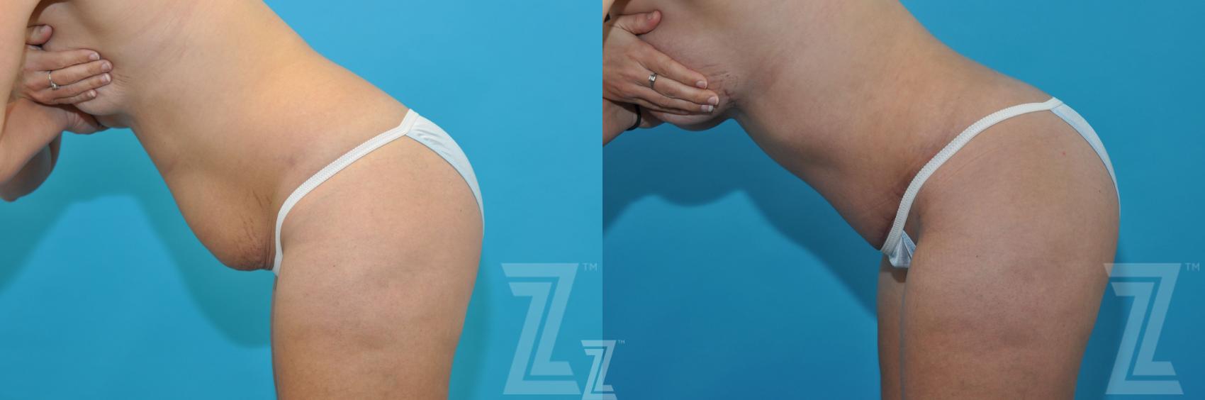 Mommy Makeover Before & After Photo | Austin, TX | The Piazza Center for Plastic Surgery & Advanced Skin Care