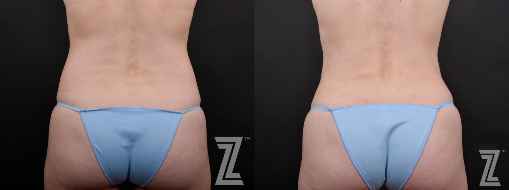 Mommy Makeover Before & After Photo | Austin, TX | The Piazza Center for Plastic Surgery & Advanced Skin Care
