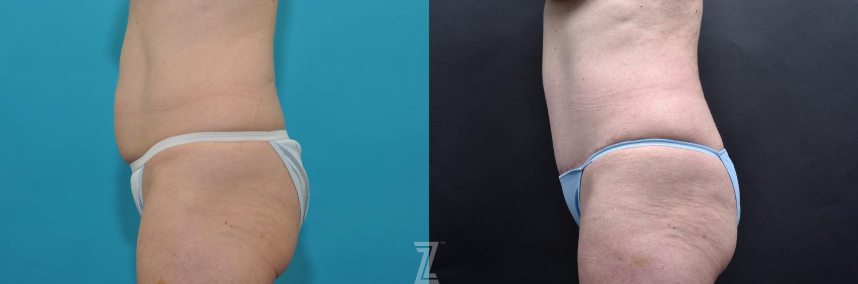 Mommy Makeover Before & After Photo | Austin, TX | The Piazza Center for Plastic Surgery & Advanced Skin Care
