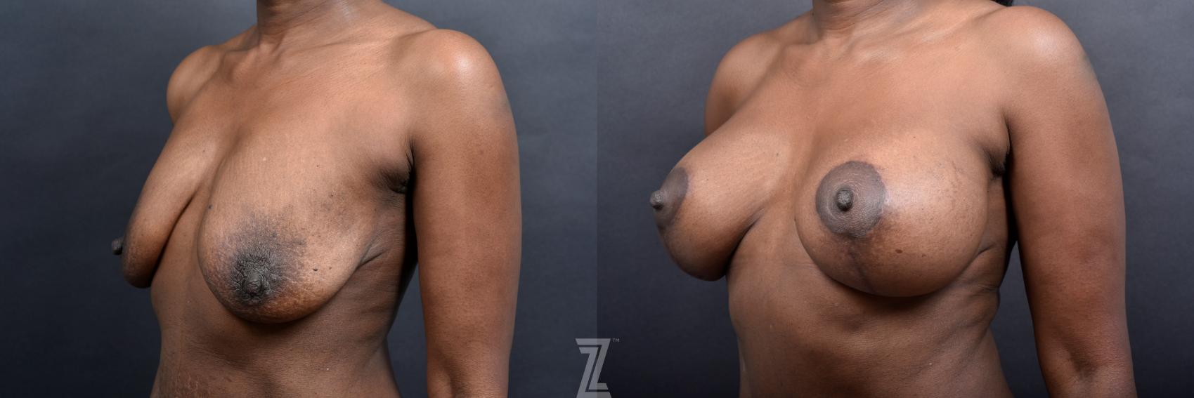 Mommy Makeover Before & After Photo | Austin, TX | The Piazza Center for Plastic Surgery & Advanced Skin Care