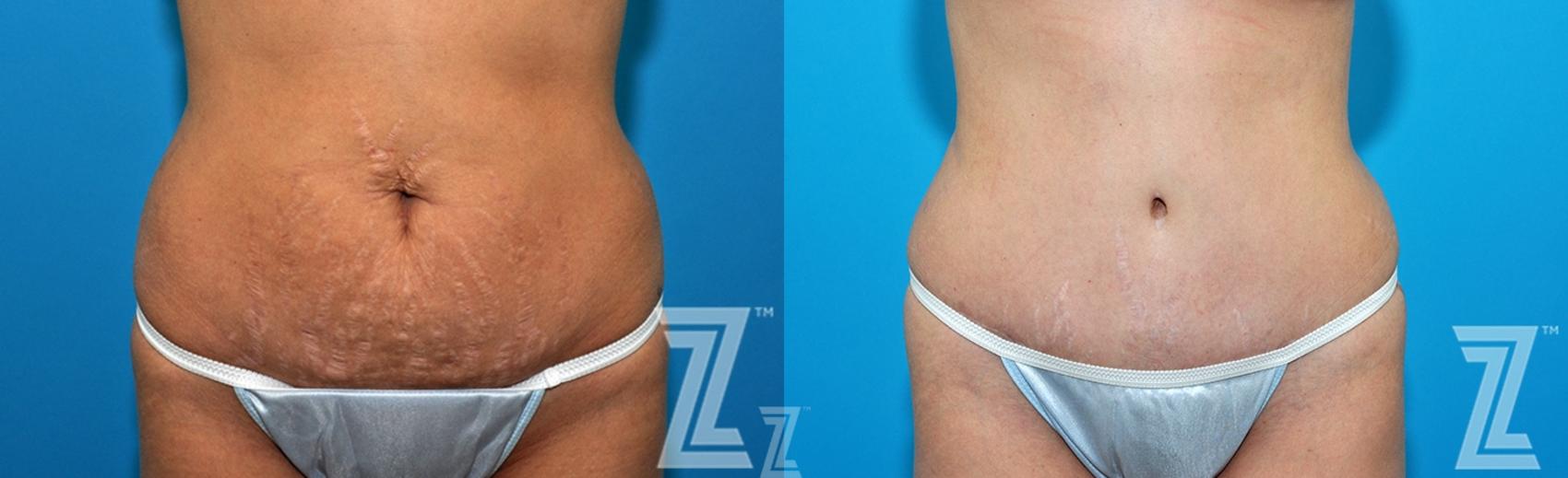 Mommy Makeover Before & After Photo | Austin, TX | The Piazza Center for Plastic Surgery & Advanced Skin Care