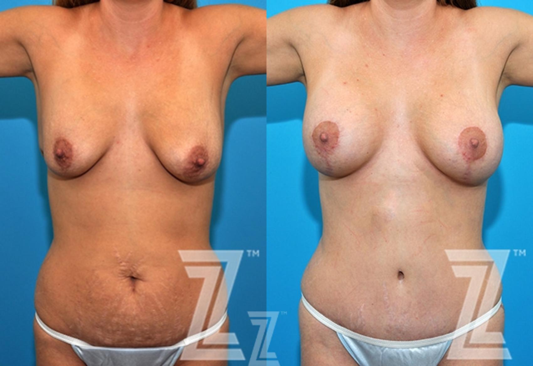 Mommy Makeover Before & After Photo | Austin, TX | The Piazza Center for Plastic Surgery & Advanced Skin Care