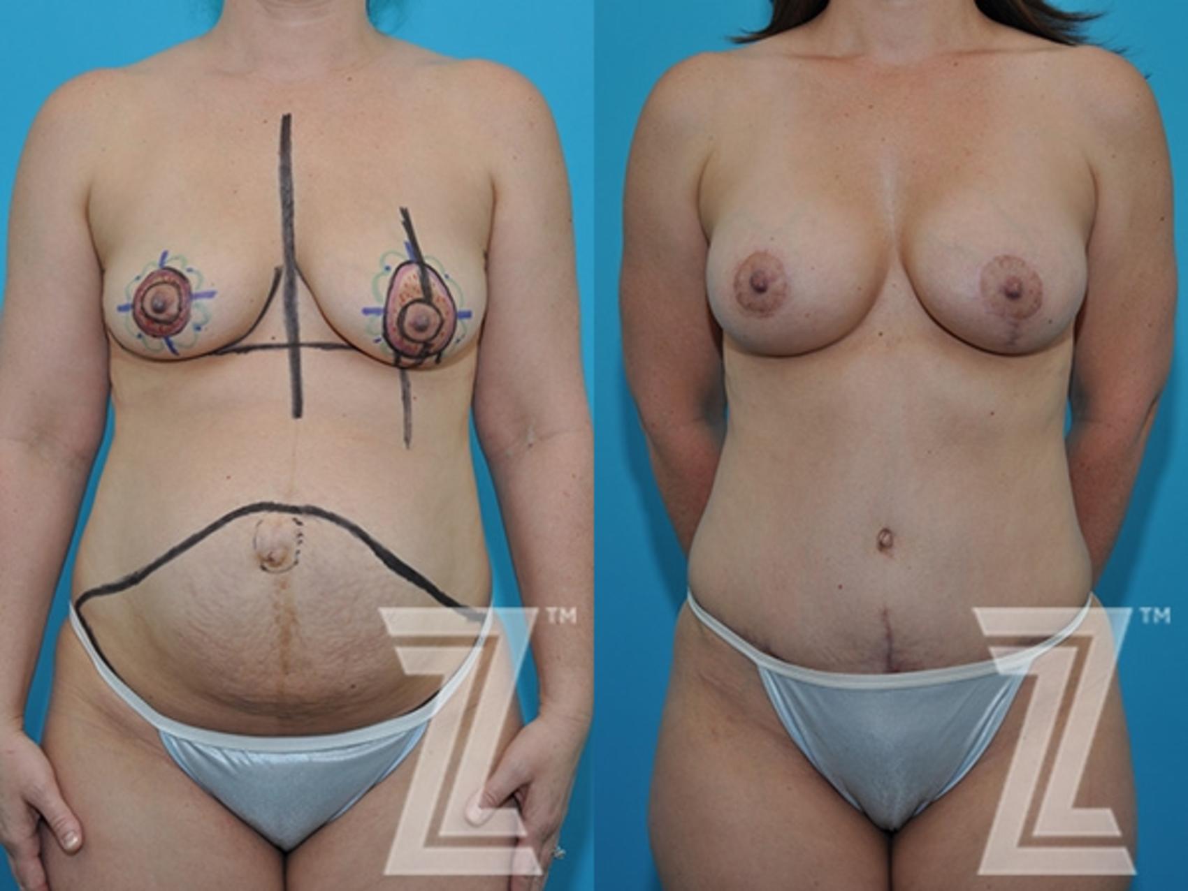 Mommy Makeover Before & After Photo | Austin, TX | The Piazza Center for Plastic Surgery & Advanced Skin Care