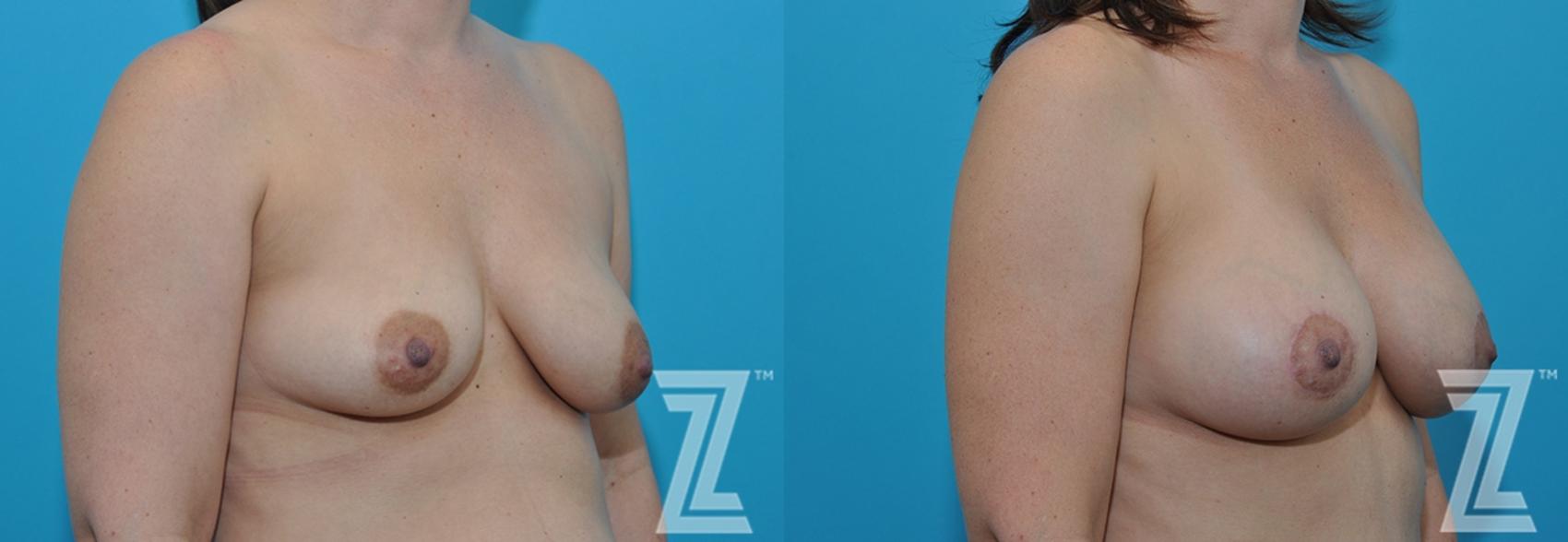 Mommy Makeover Before & After Photo | Austin, TX | The Piazza Center for Plastic Surgery & Advanced Skin Care