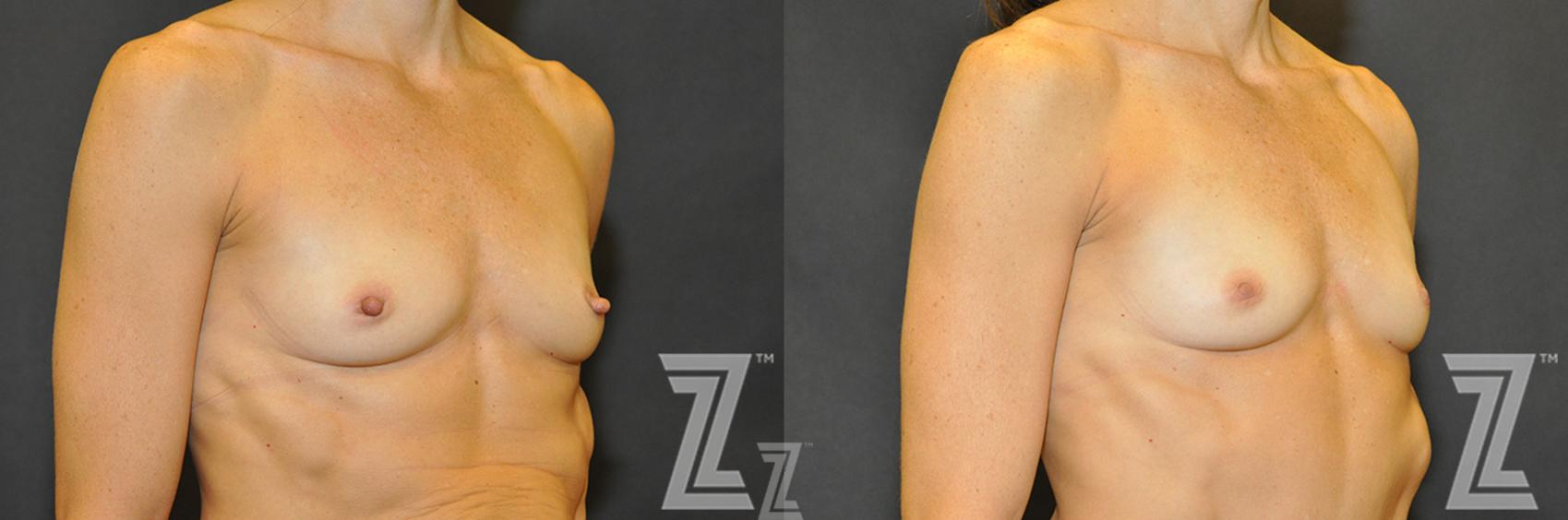 Nipple Reduction Before & After Photo | Austin, TX | The Piazza Center for Plastic Surgery & Advanced Skin Care