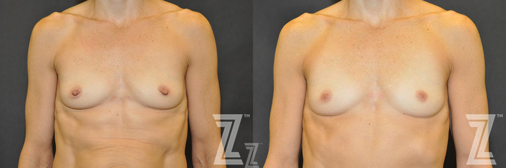Nipple Reduction Before & After Photo | Austin, TX | The Piazza Center for Plastic Surgery & Advanced Skin Care