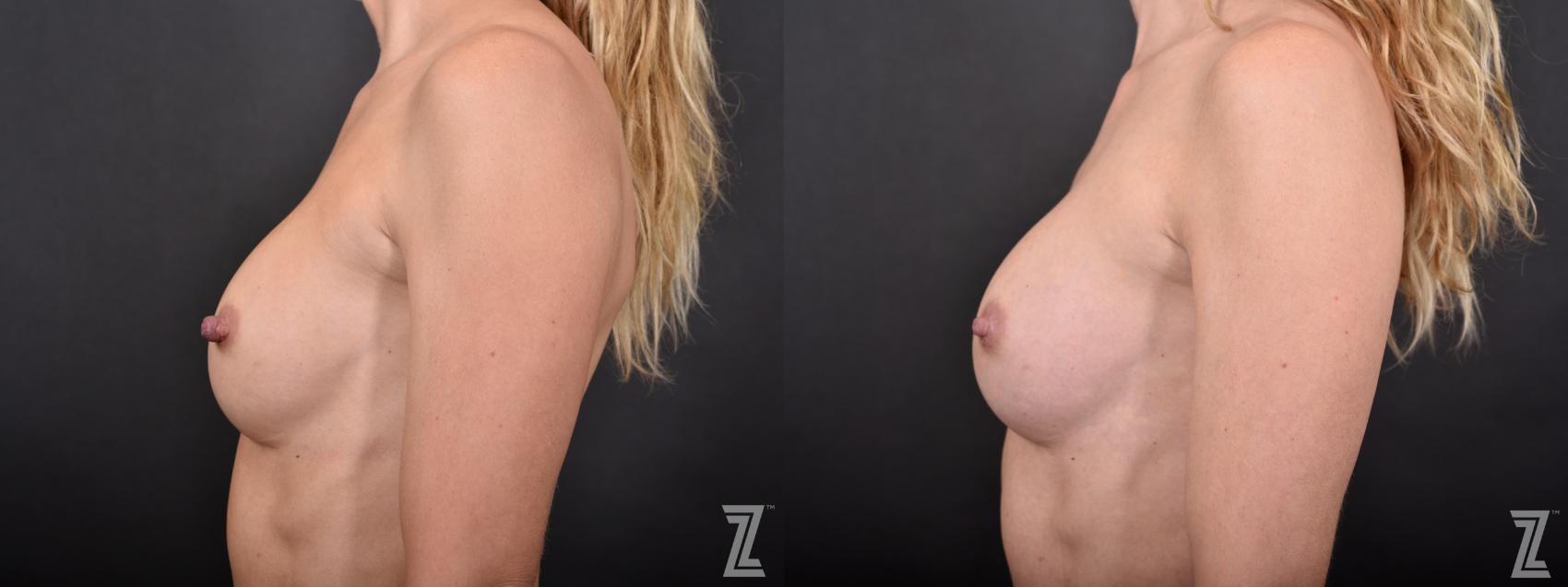 Nipple Reduction Before & After Photo | Austin, TX | The Piazza Center for Plastic Surgery & Advanced Skin Care