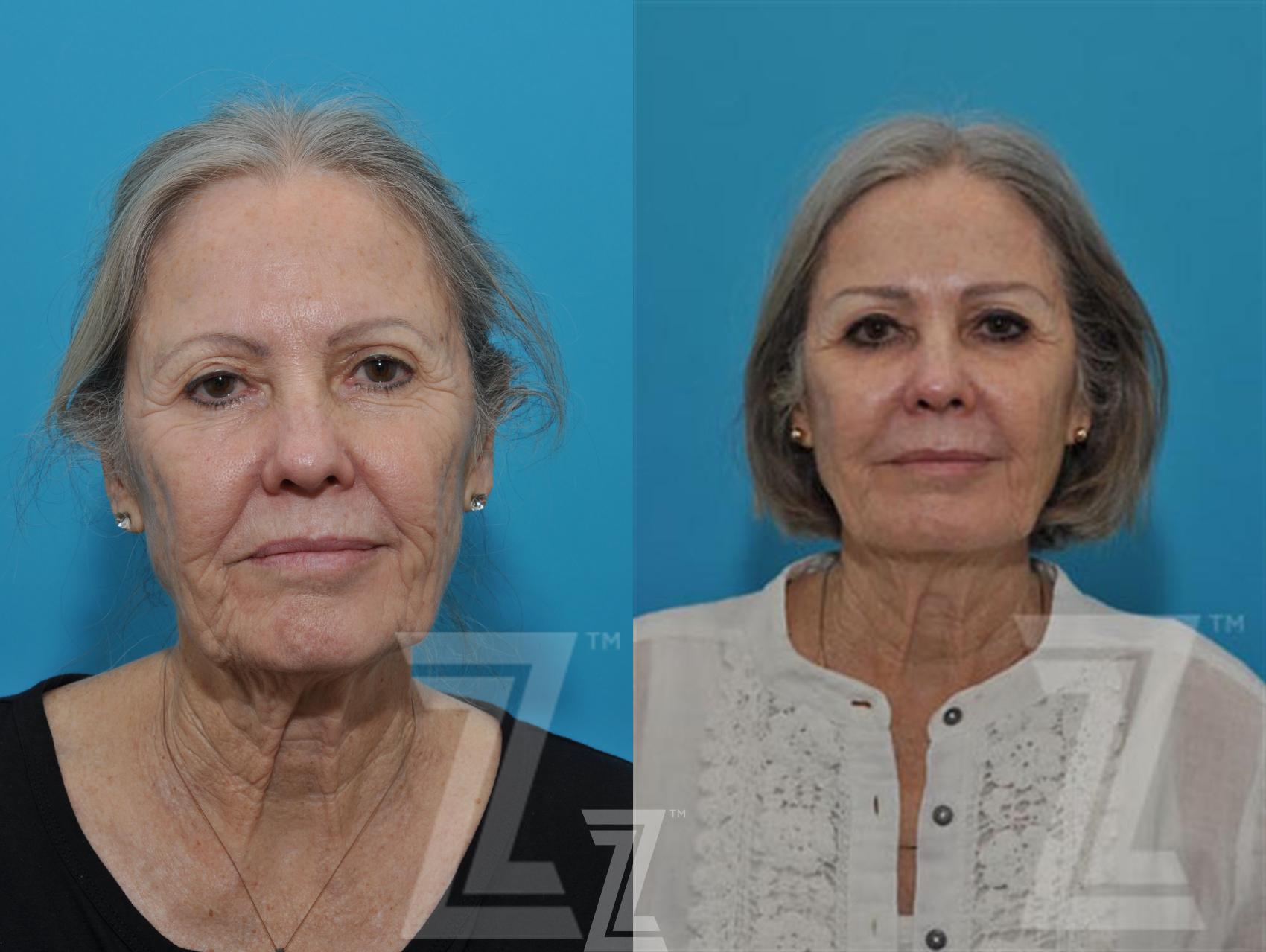 Sculptra® Before & After Photo | Austin, TX | The Piazza Center for Plastic Surgery & Advanced Skin Care