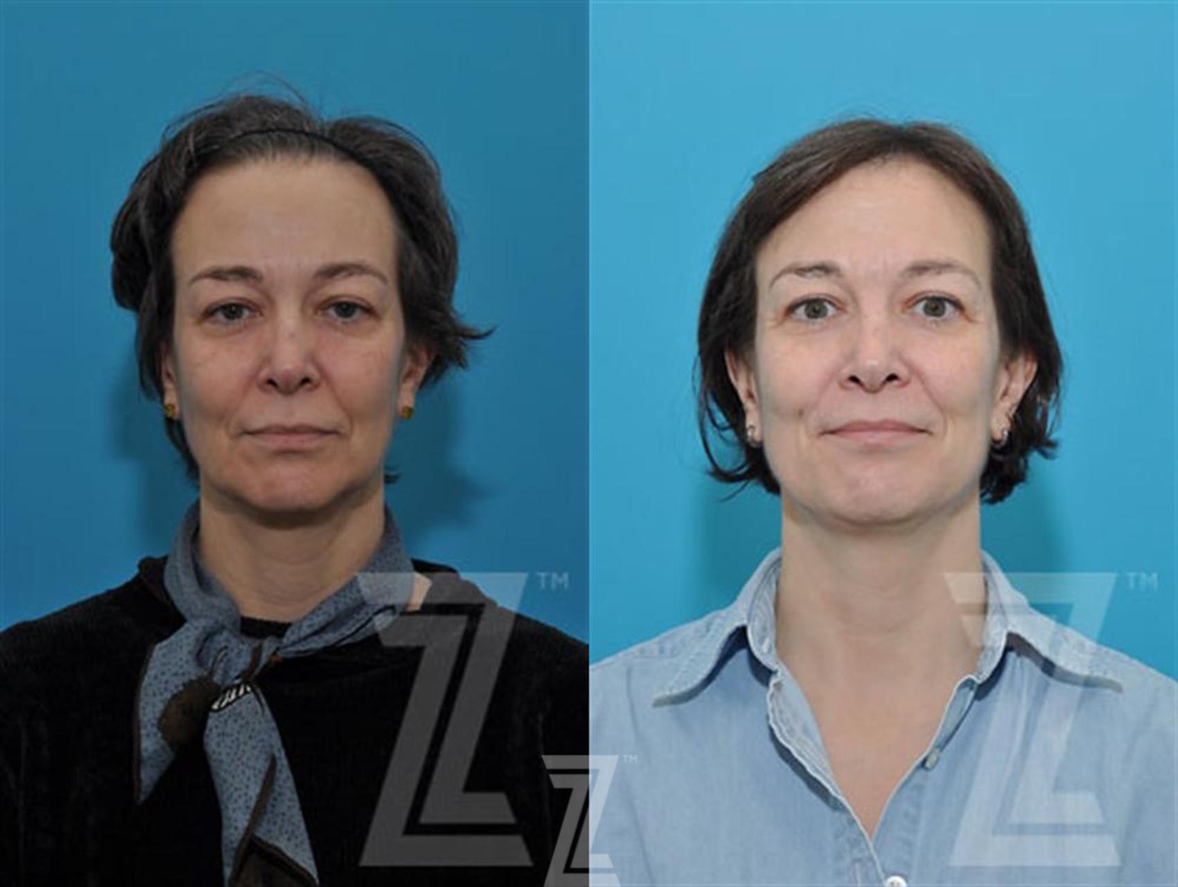 Sculptra® Before & After Photo | Austin, TX | The Piazza Center for Plastic Surgery & Advanced Skin Care