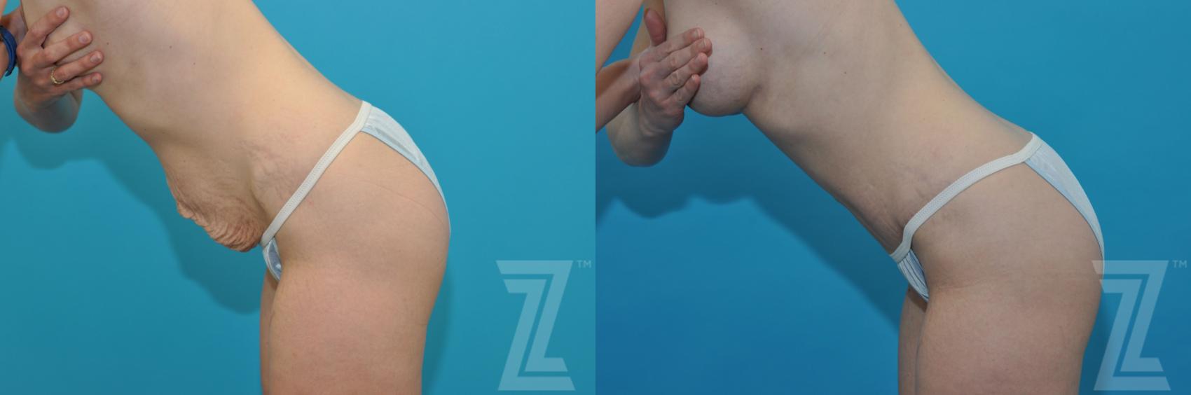 Tummy Tuck Before & After Photo | Austin, TX | The Piazza Center for Plastic Surgery & Advanced Skin Care
