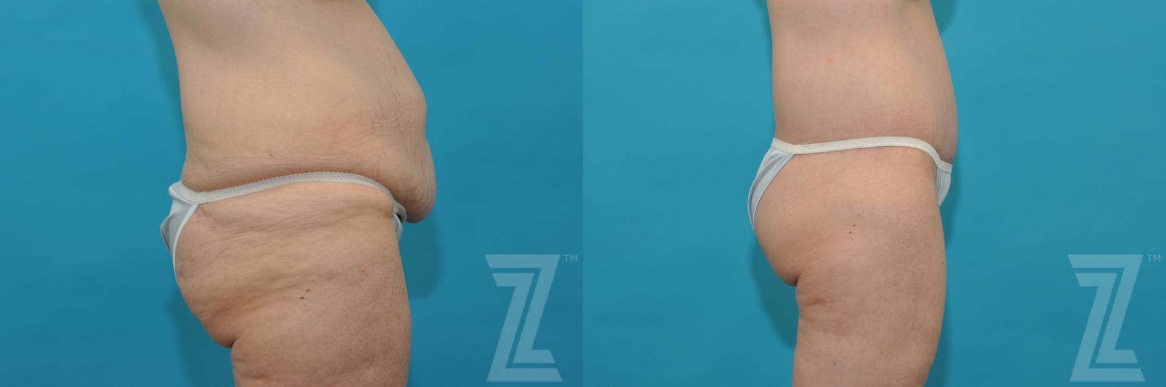 tummy tuck scars after 5 years tummy tuck scars after 5 years