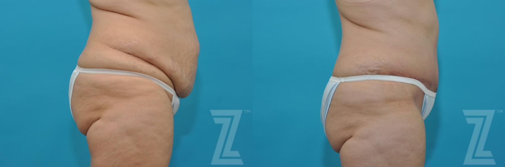 Tummy Tuck Before & After Photos Patient 202 | Austin, TX | The Piazza