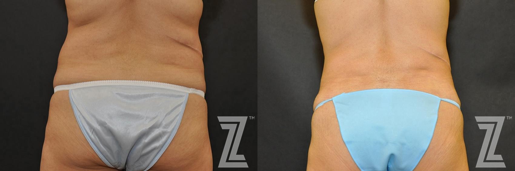 Tummy Tuck Before & After Photo | Austin, TX | The Piazza Center for Plastic Surgery & Advanced Skin Care
