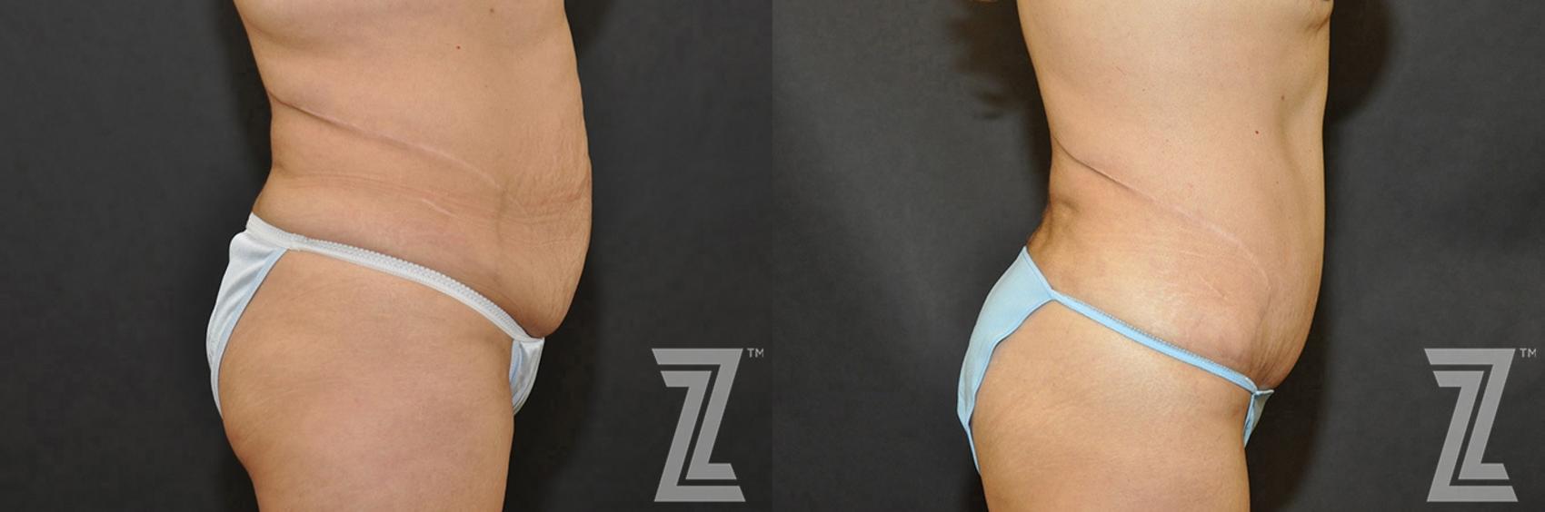 Tummy Tuck Before & After Photo | Austin, TX | The Piazza Center for Plastic Surgery & Advanced Skin Care