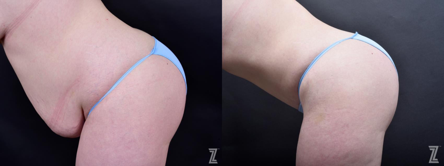 Tummy Tuck Before & After Photo | Austin, TX | The Piazza Center for Plastic Surgery & Advanced Skin Care