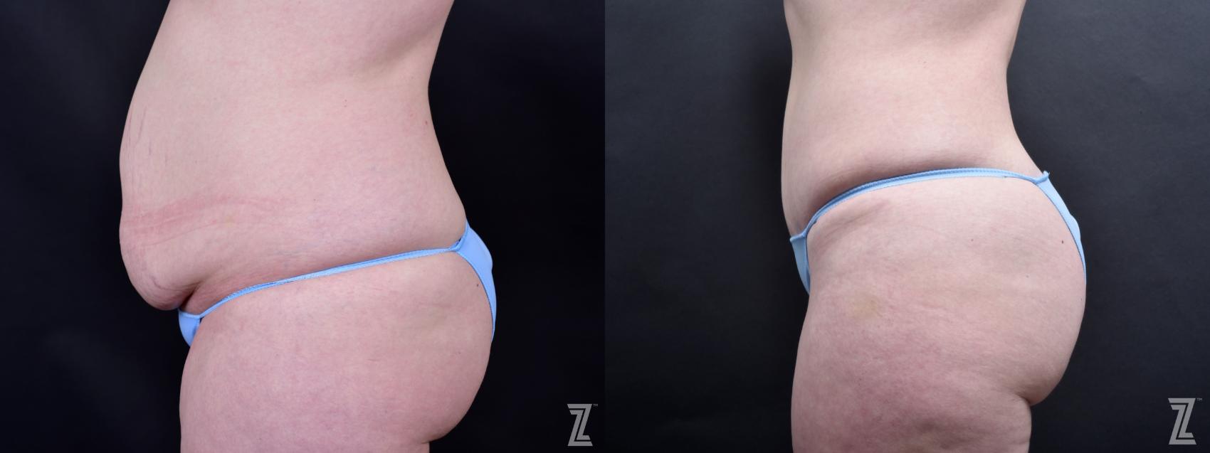 Tummy Tuck Before & After Photo | Austin, TX | The Piazza Center for Plastic Surgery & Advanced Skin Care