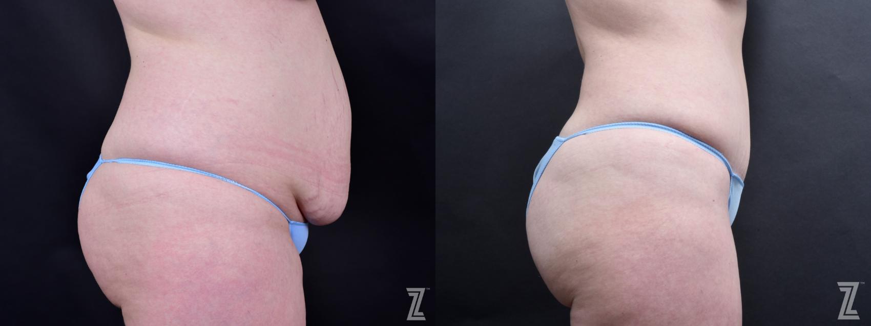 Tummy Tuck Before & After Photo | Austin, TX | The Piazza Center for Plastic Surgery & Advanced Skin Care