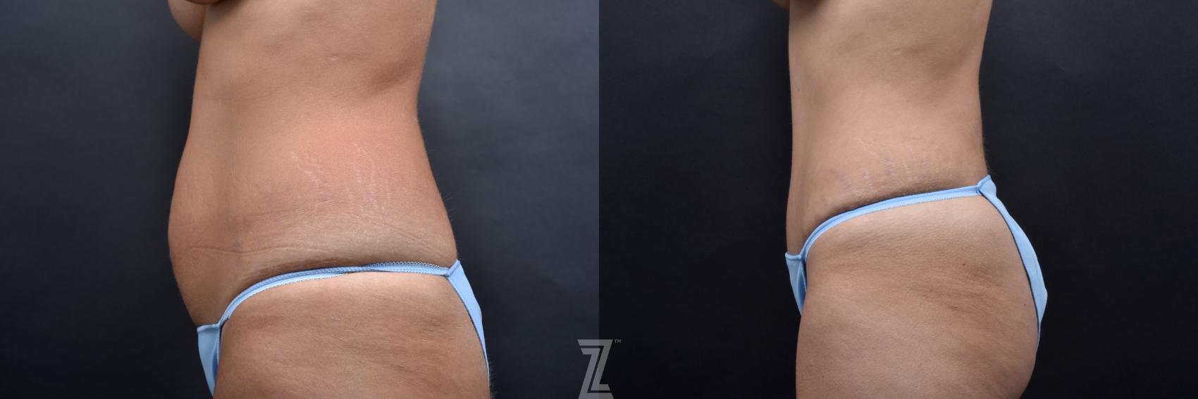 Tummy Tuck Before & After Photo | Austin, TX | The Piazza Center for Plastic Surgery & Advanced Skin Care