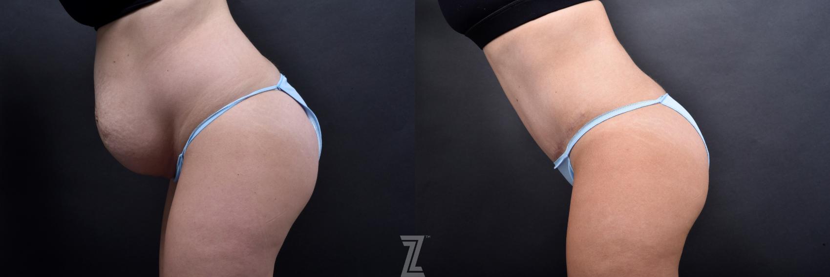 Tummy Tuck Before & After Photo | Austin, TX | The Piazza Center for Plastic Surgery & Advanced Skin Care