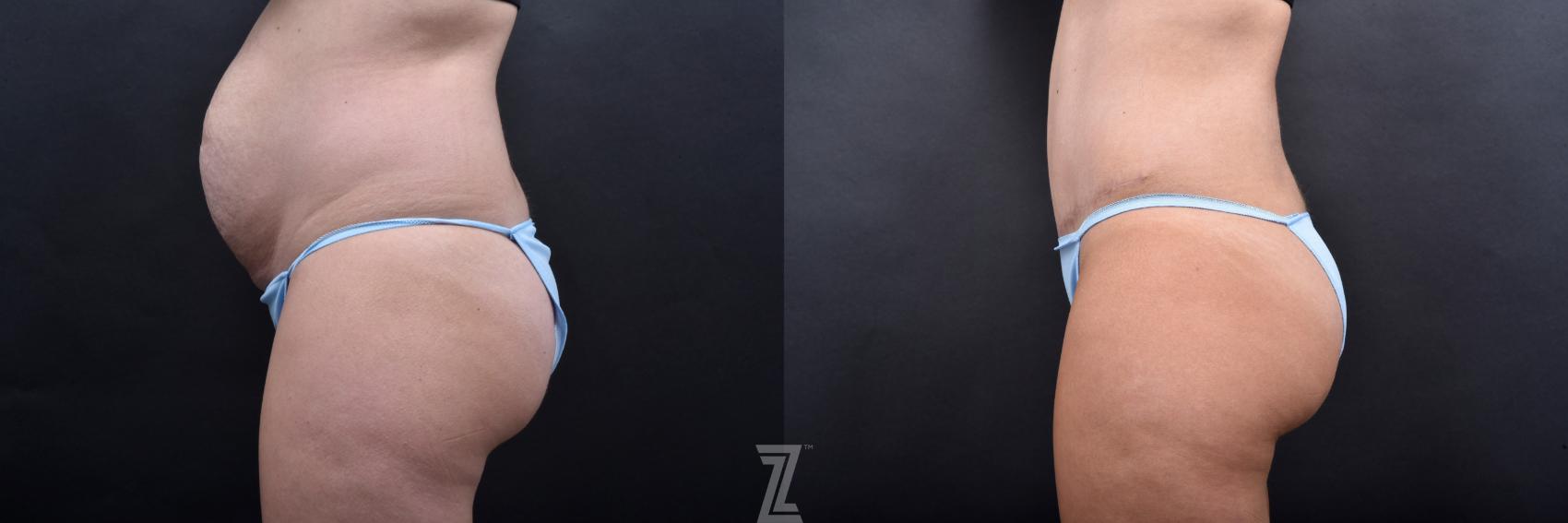 Tummy Tuck Before & After Photo | Austin, TX | The Piazza Center for Plastic Surgery & Advanced Skin Care