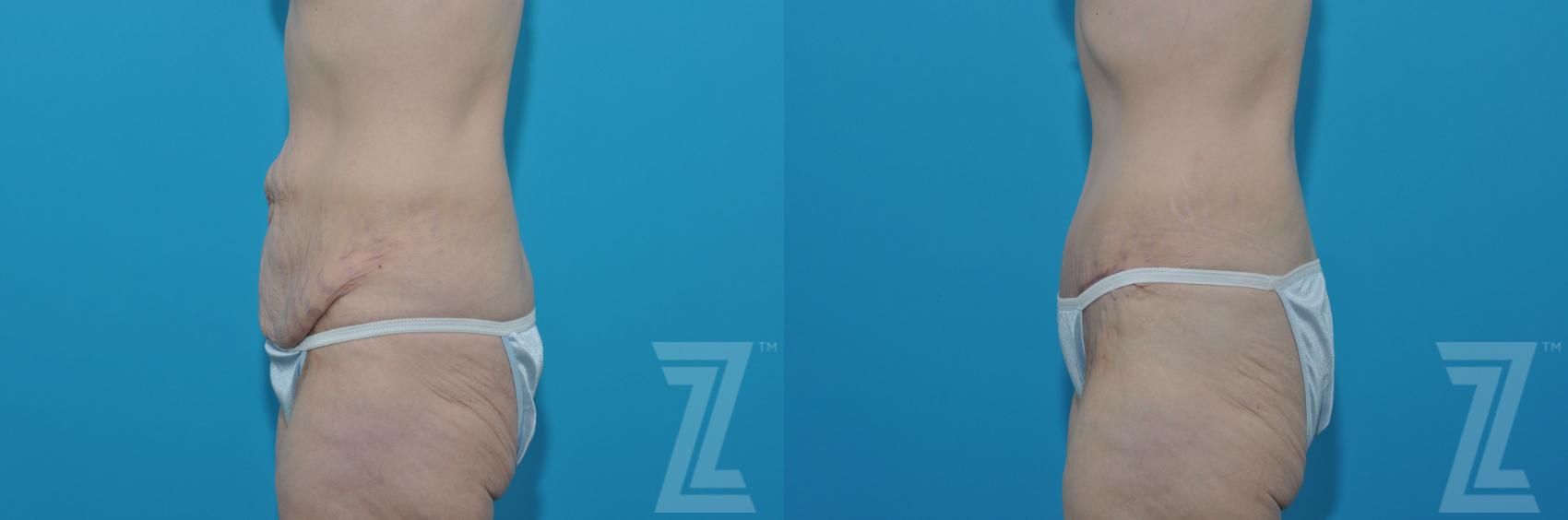 C Section Tummy Tuck Combo