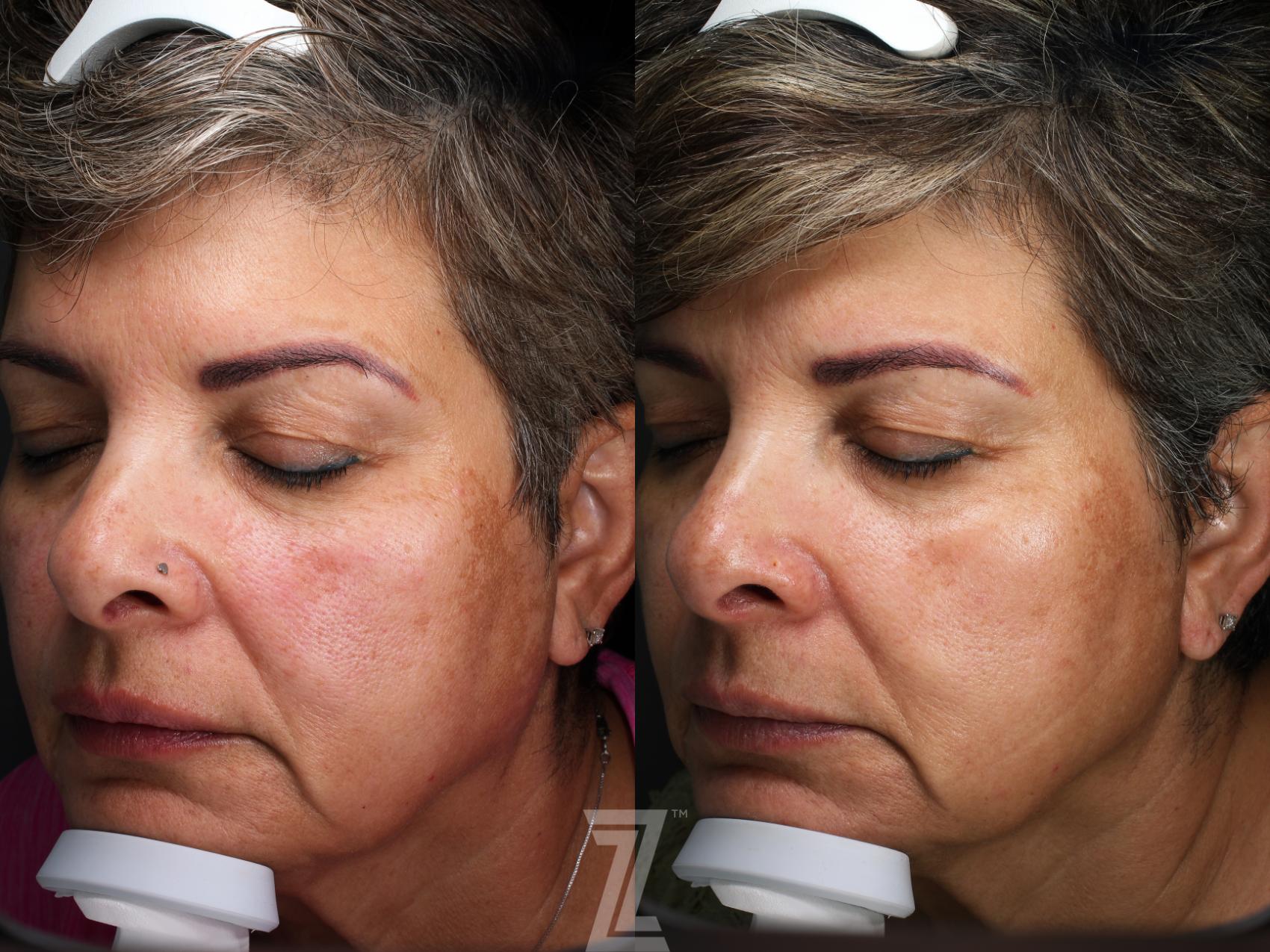 Botox, visia skin analysis, Neurotoxin, Dysport, Before and After, B&A, Tummy Tuck, Breast Aug, Breast Lift, Mastopexy, MMO, Mommy Makeover, Dr. Rocco Piazza, The Piazza Center, melasma, moxi, Austin, Tx, Halo, BBLlaser