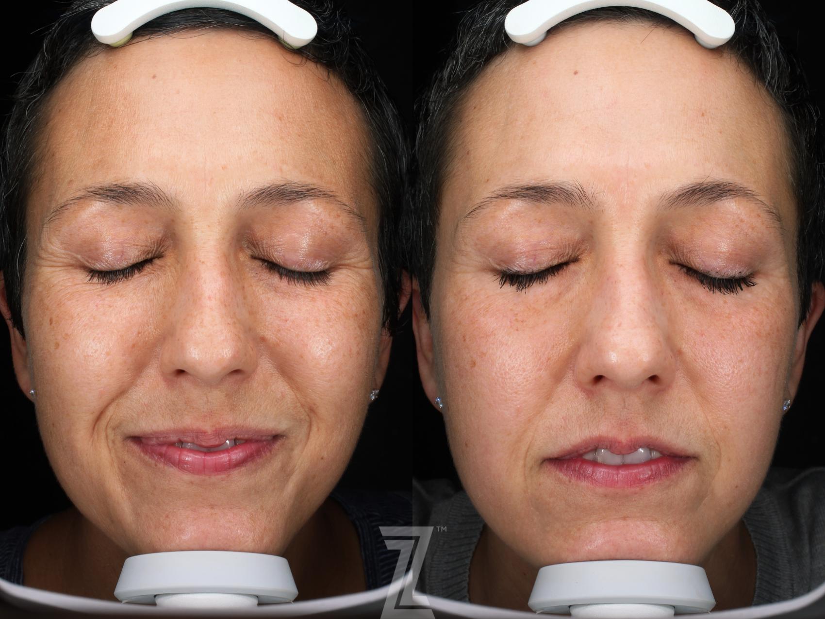 Visia Skincare Analysis  Before & After Photo | Austin, TX | The Piazza Center for Plastic Surgery & Advanced Skin Care